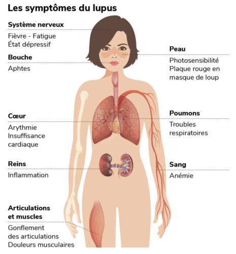 Infographie sur les symptômes du lupus