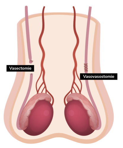 Infographie Vasectomie - Vasovasostomie
